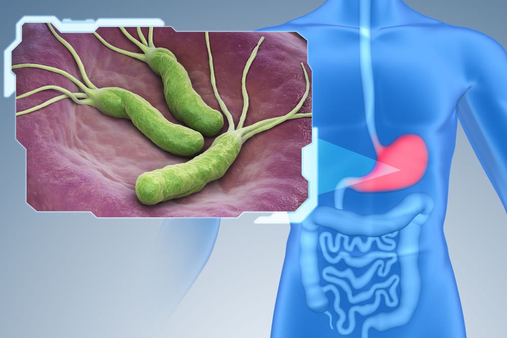 Helicobacter pylori – czym jest, co wywołuje, objawy, leczenie, testy serologiczne Helicobacter pylori – czym jest, co wywołuje, objawy, leczenie, testy serologiczne